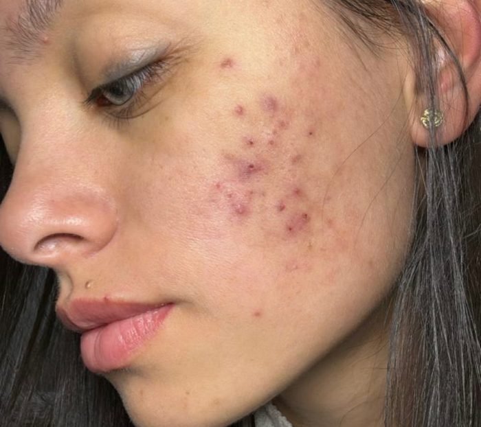 Antes — Paciente com acne ativa e cicatrizes recentes
